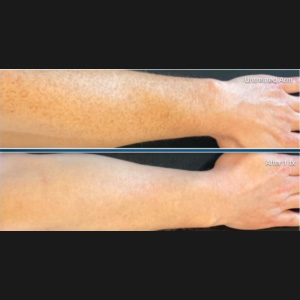 BBL Body Glow before and after