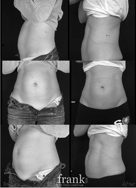 Emsculpt before and after results - September 2023