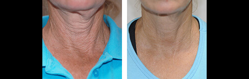 Exilis before and after results - September 2023