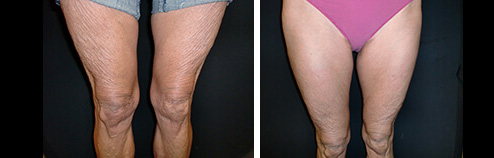 Exilis before and after results - September 2023