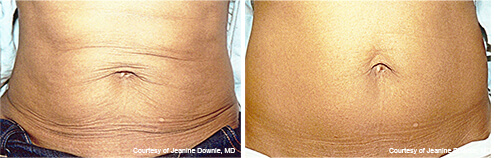 Exilis before and after results - September 2023