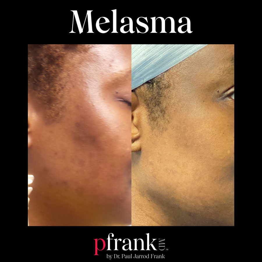 pigment protocol before and after