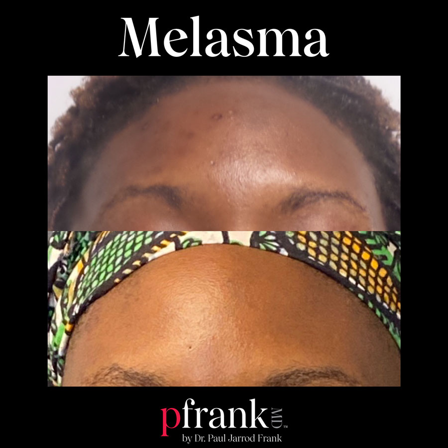 pigment protocol before and after