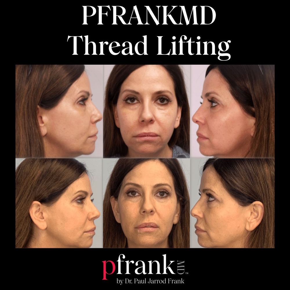Thread lift before and after results - September 2023