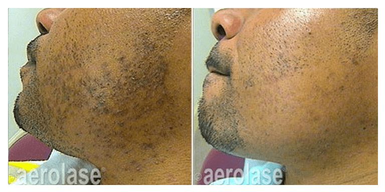 aerolase before and after