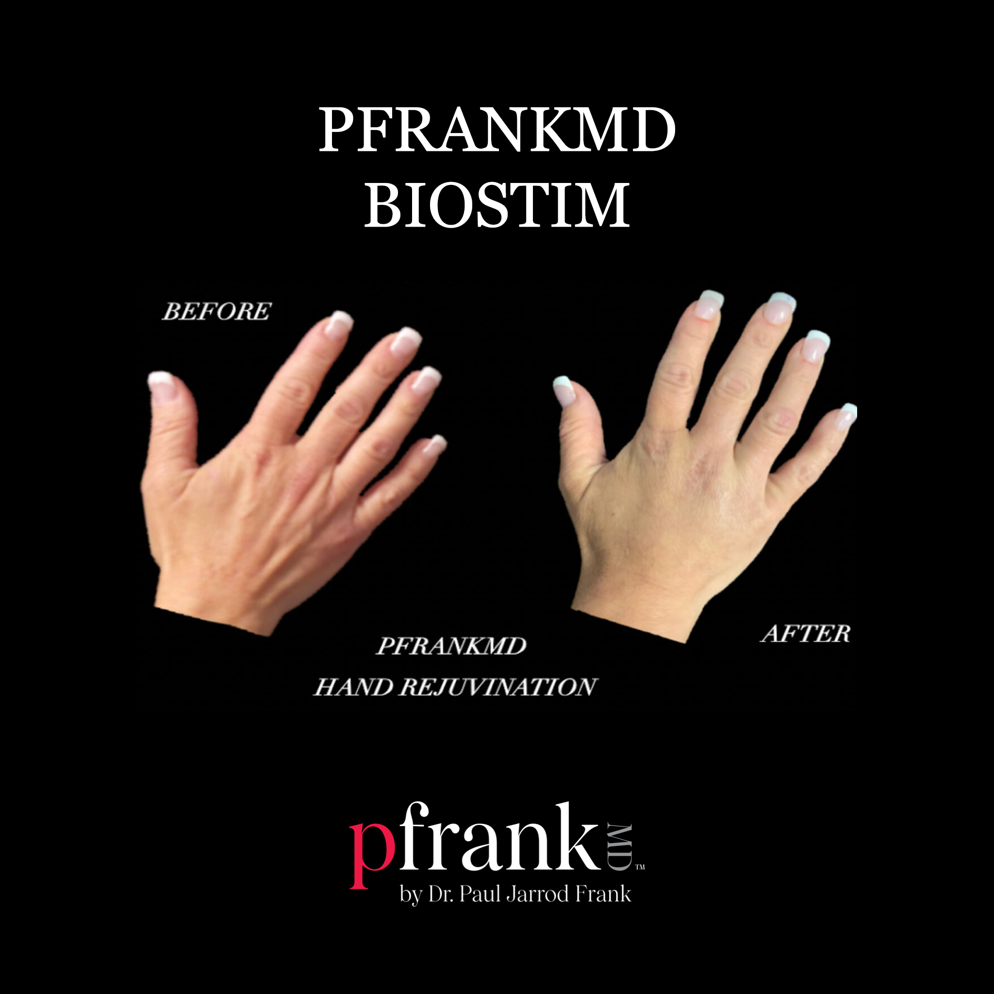 Biostim Treatment before and after