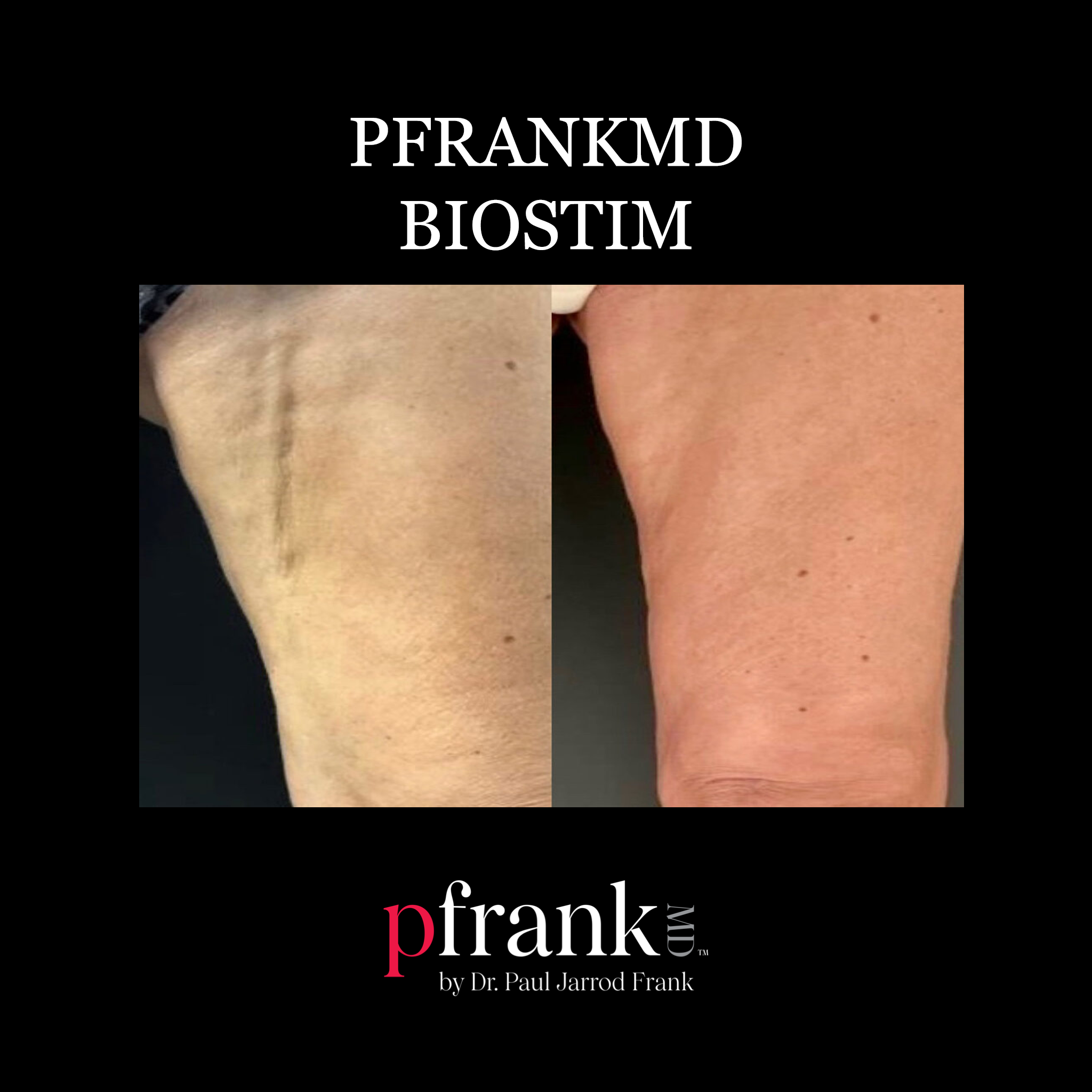 Biostim Treatment before and after