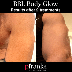 Body Glow treatment image 1 - October 2023