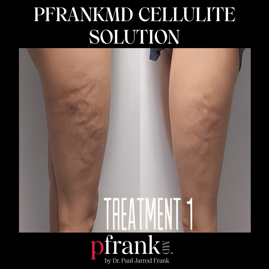 Cellulite treatment side view - October 2023