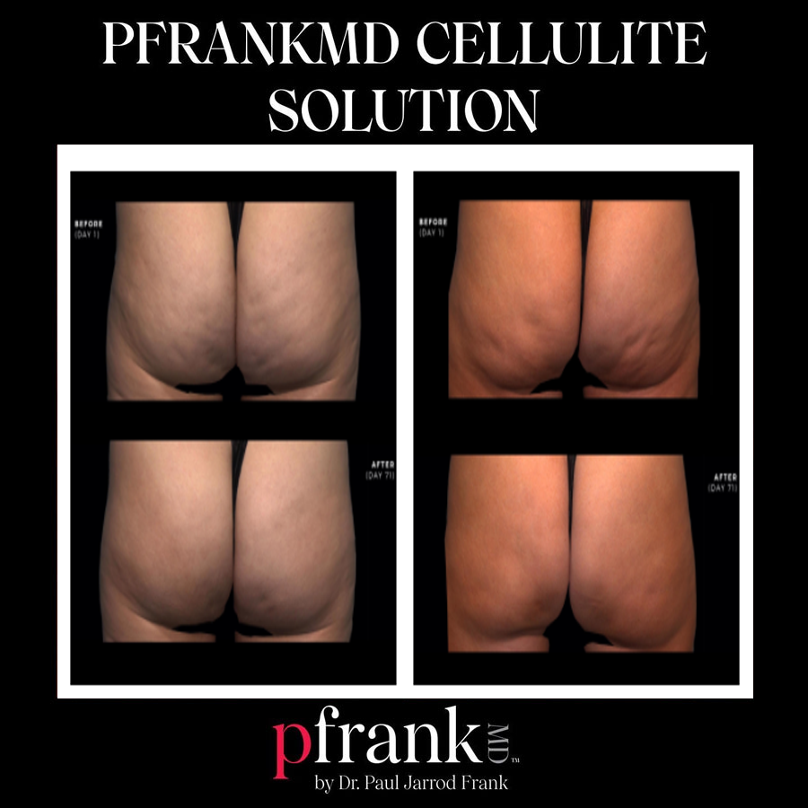 Cellulite treatment results - October 2023