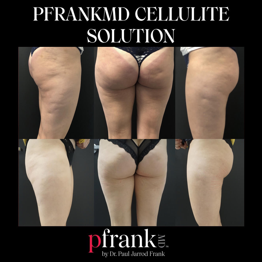 Cellulite treatment results - October 2023