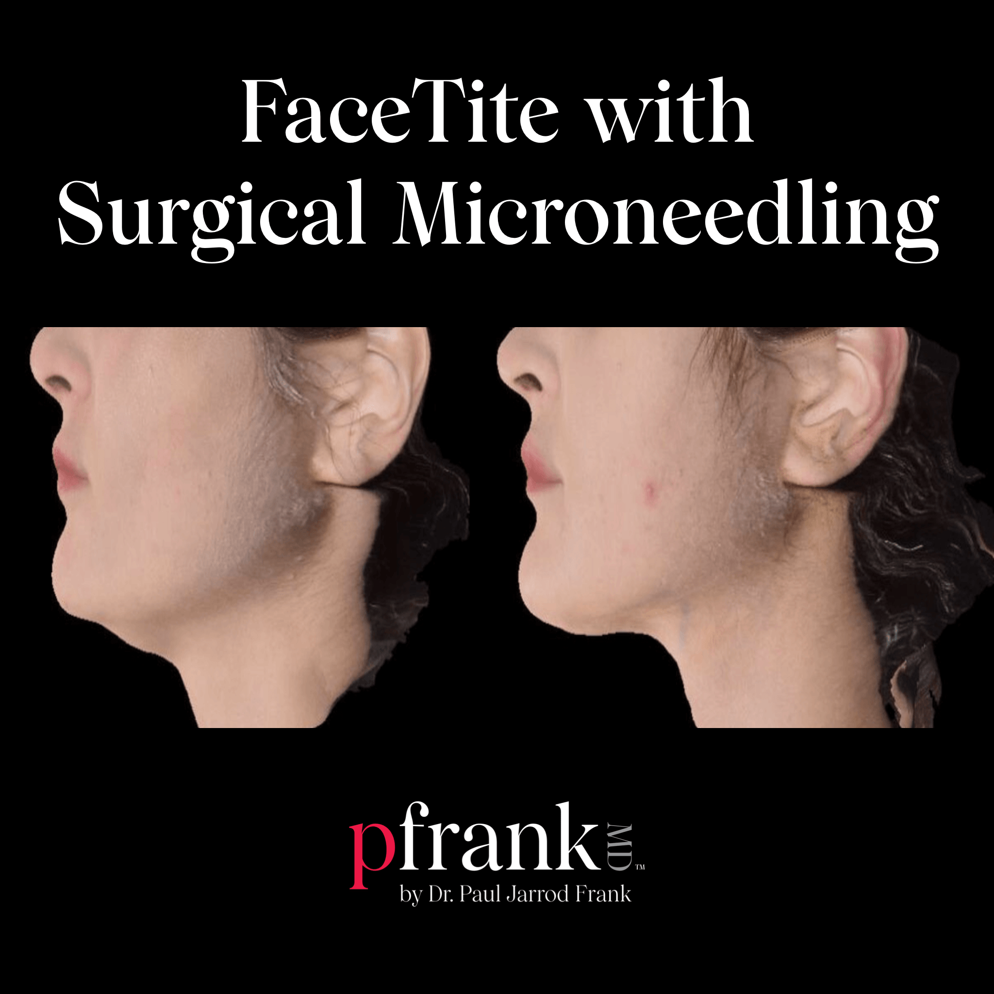facetite before and after