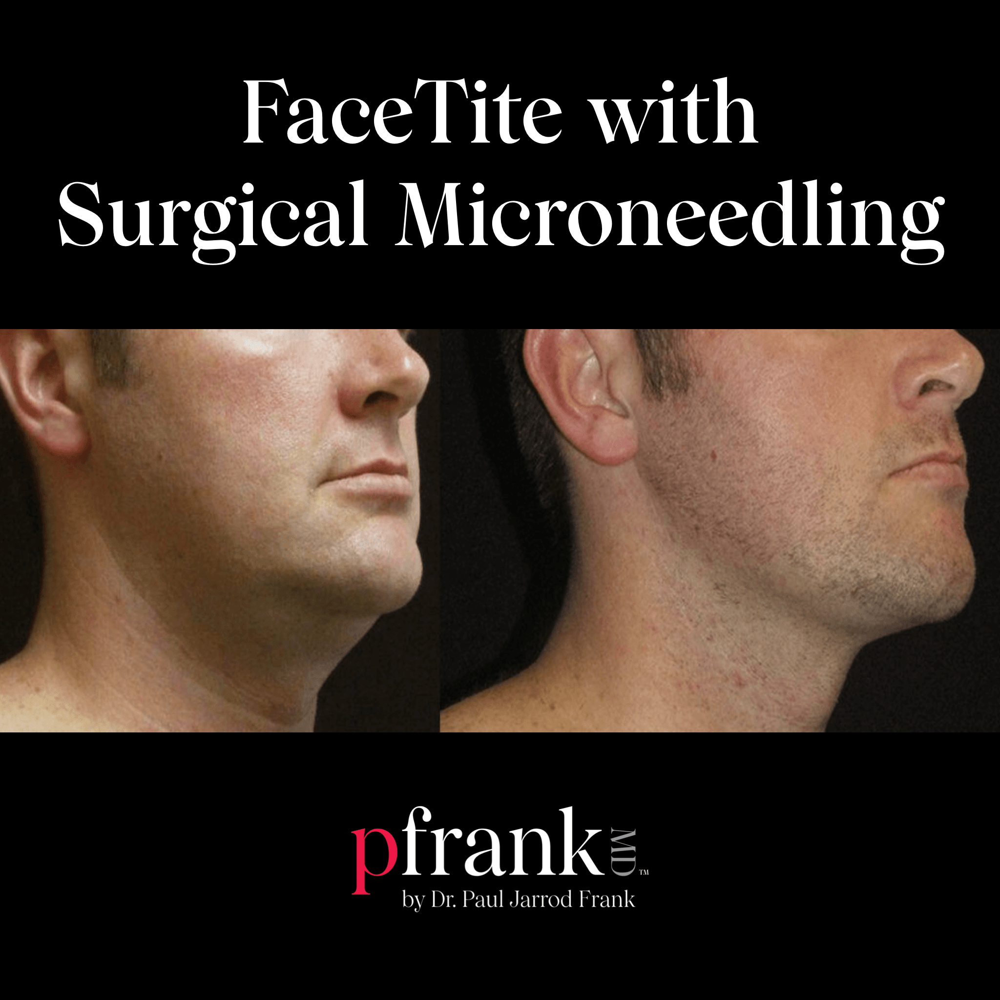 facetite before and after