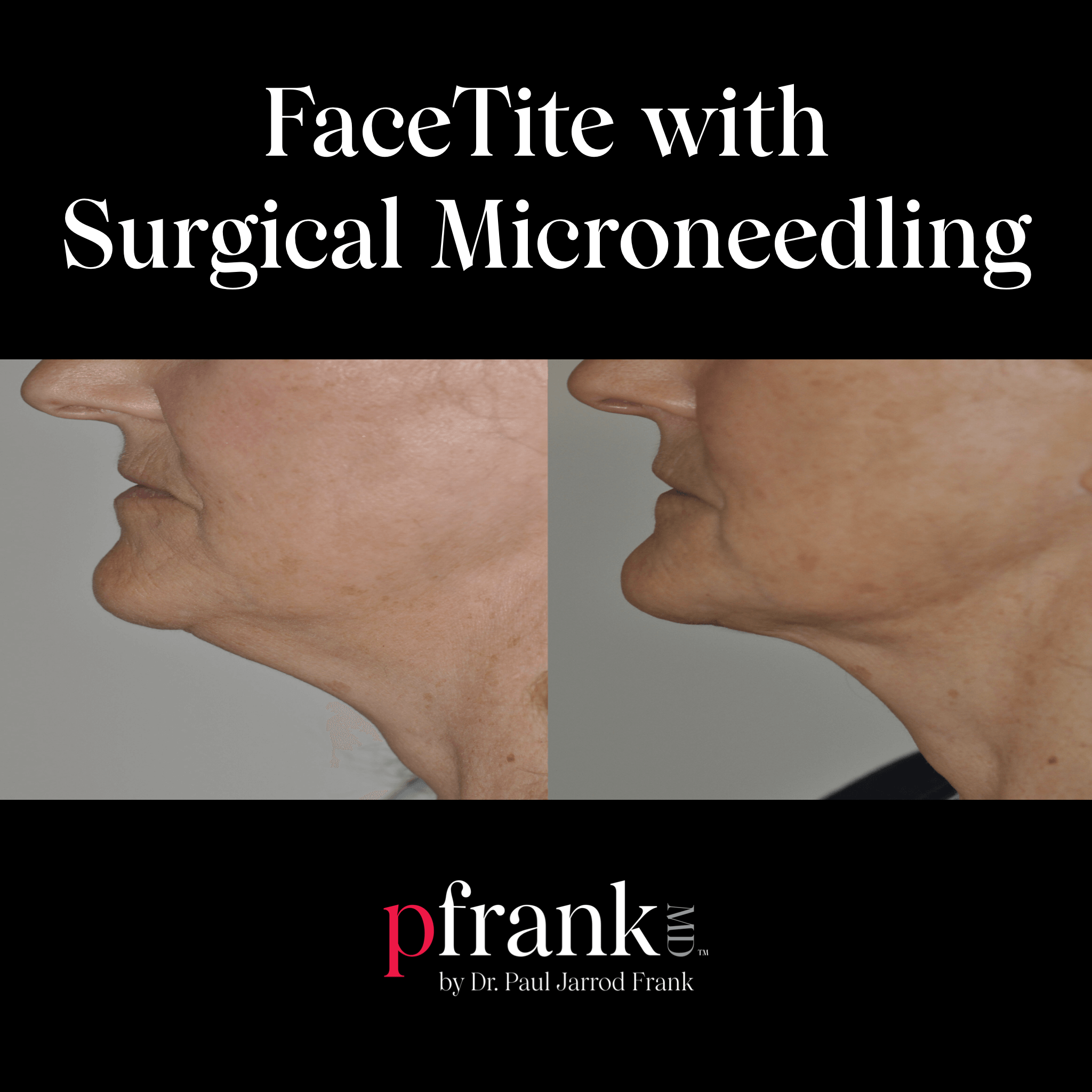 facetite before and after
