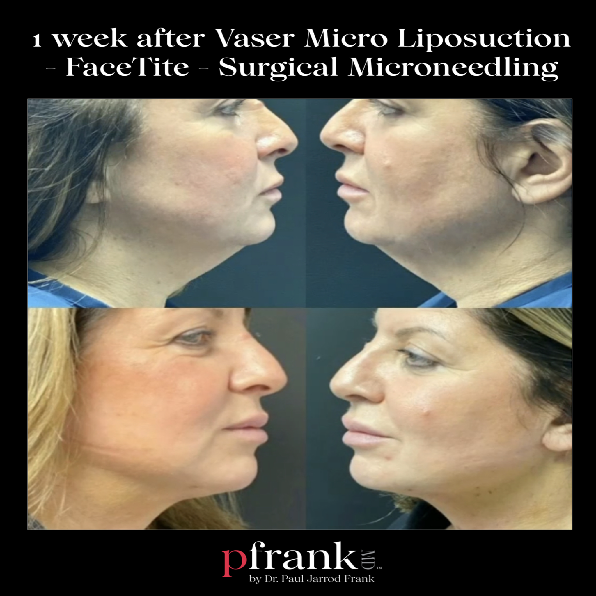 neck rejuvenation before and after
