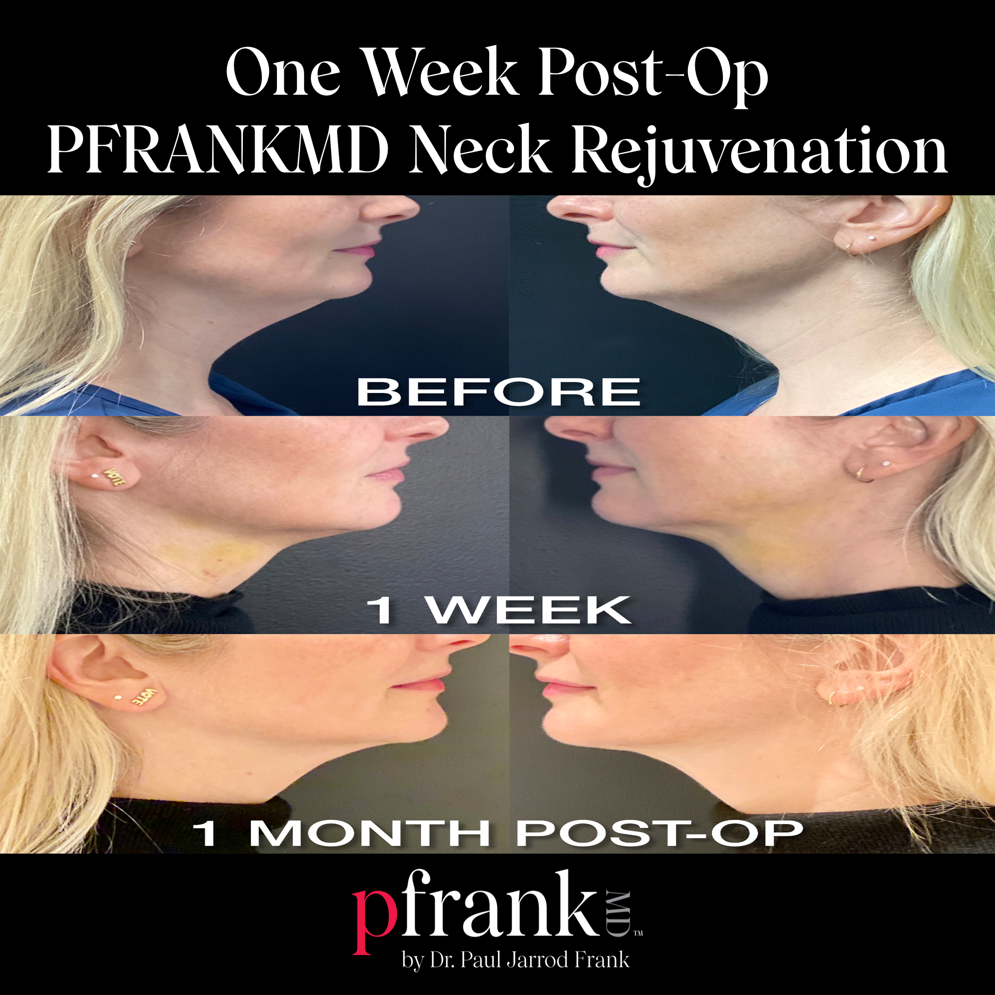 Rejuvenation treatment - October 2023