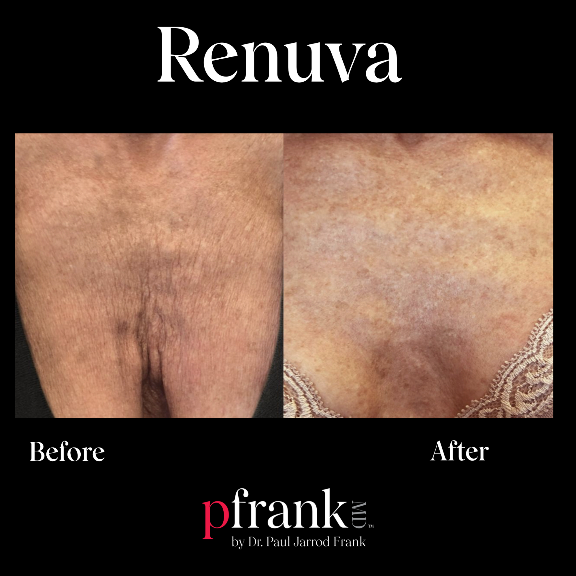Renuva treatment image 1 - October 2023
