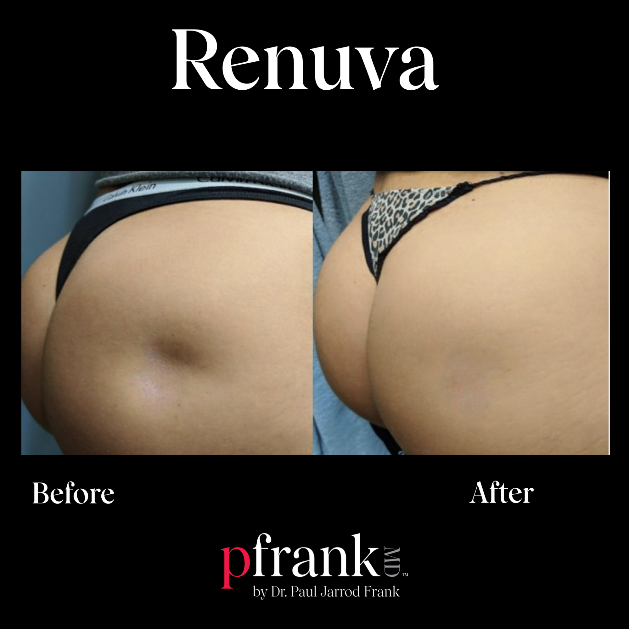 Renuva treatment - October 2023