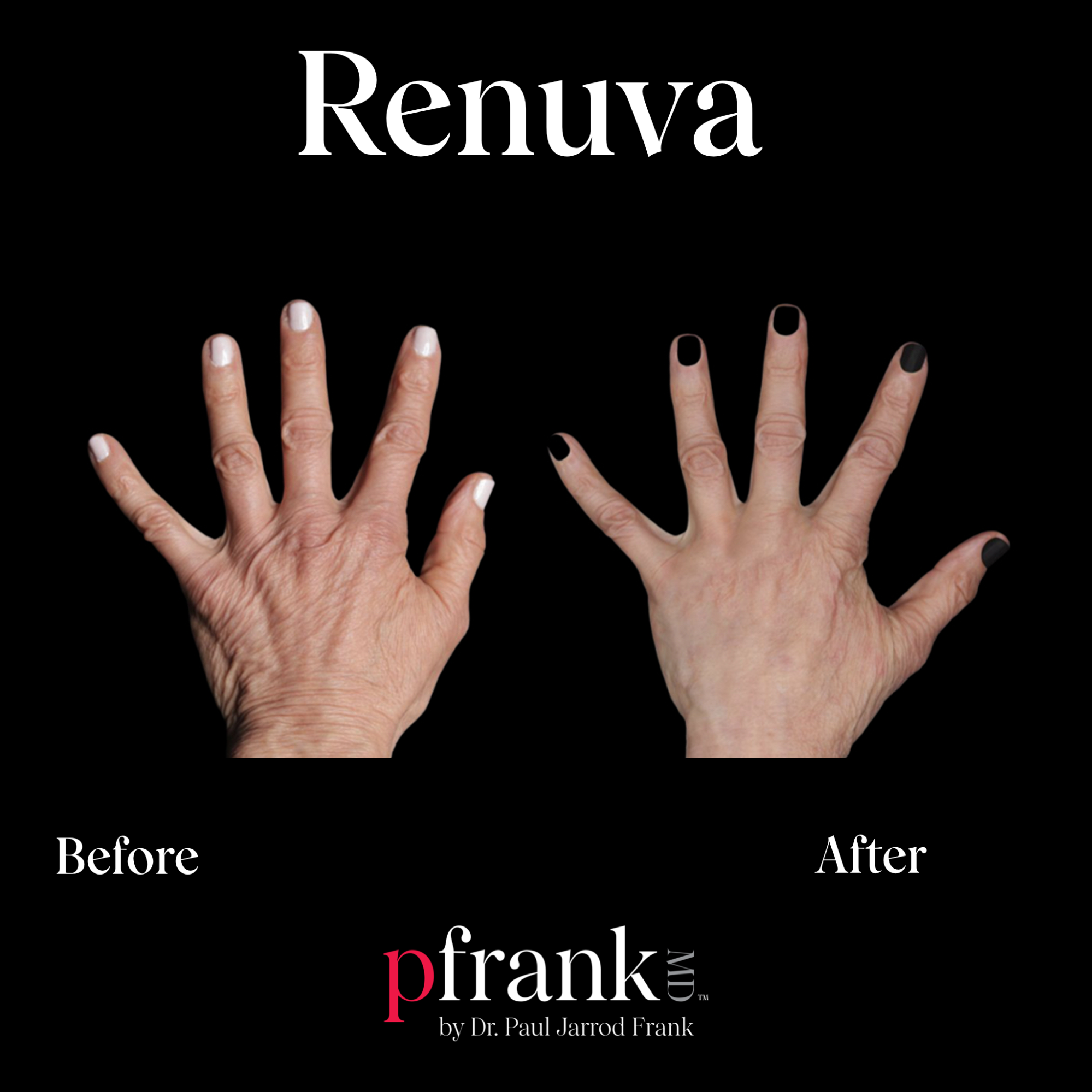 Renuva treatment image 3 - October 2023