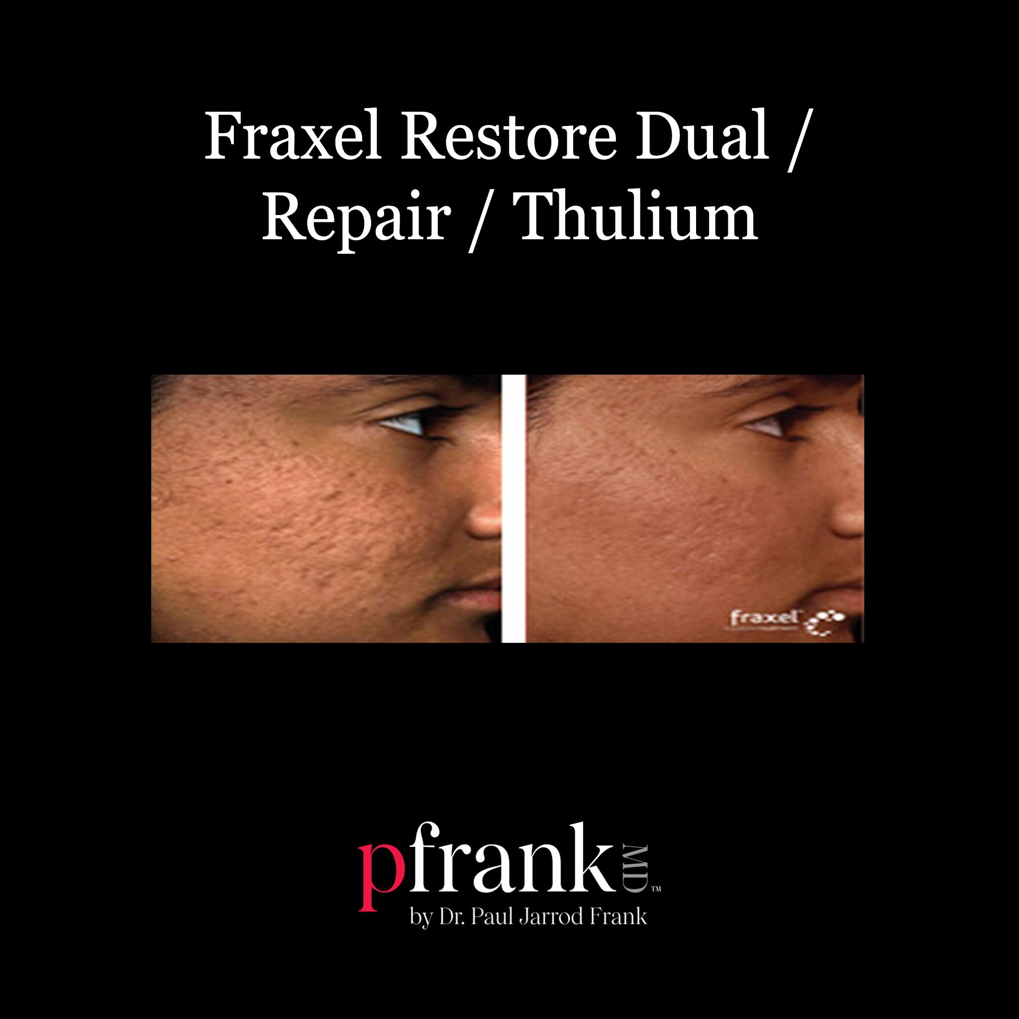 Thulium laser treatment results - October 2023