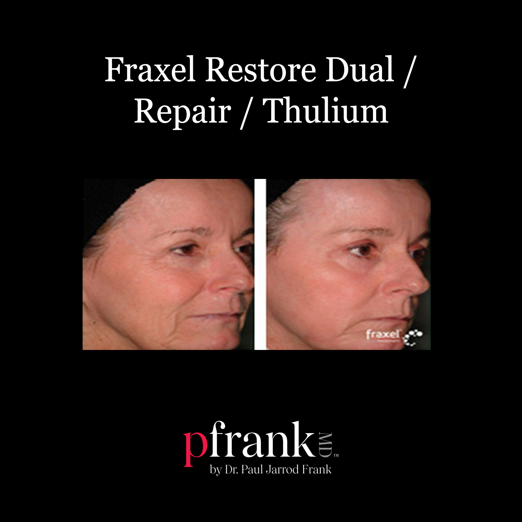 Thulium laser treatment front view - October 2023