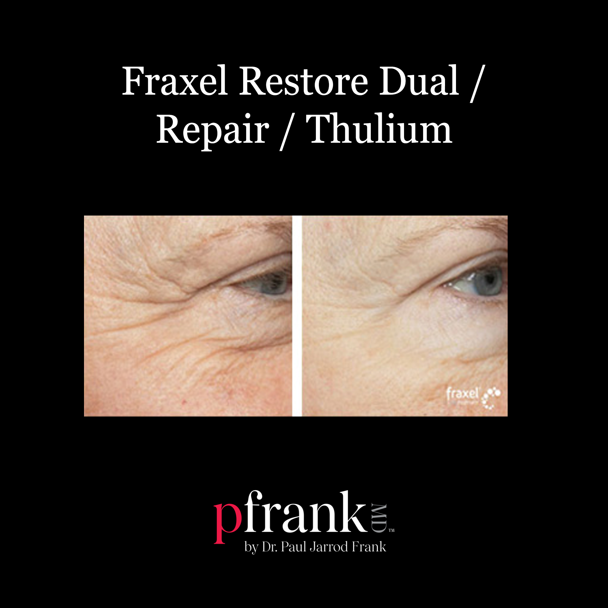 Thulium laser treatment back view - October 2023