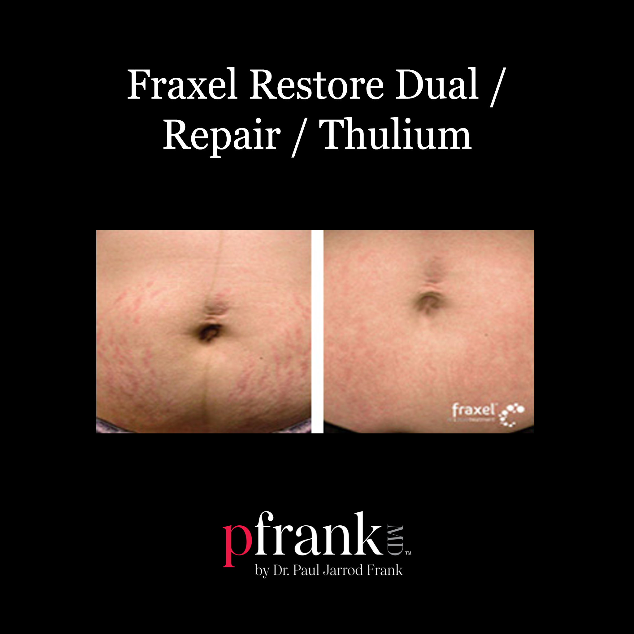 Thulium laser treatment side view - October 2023