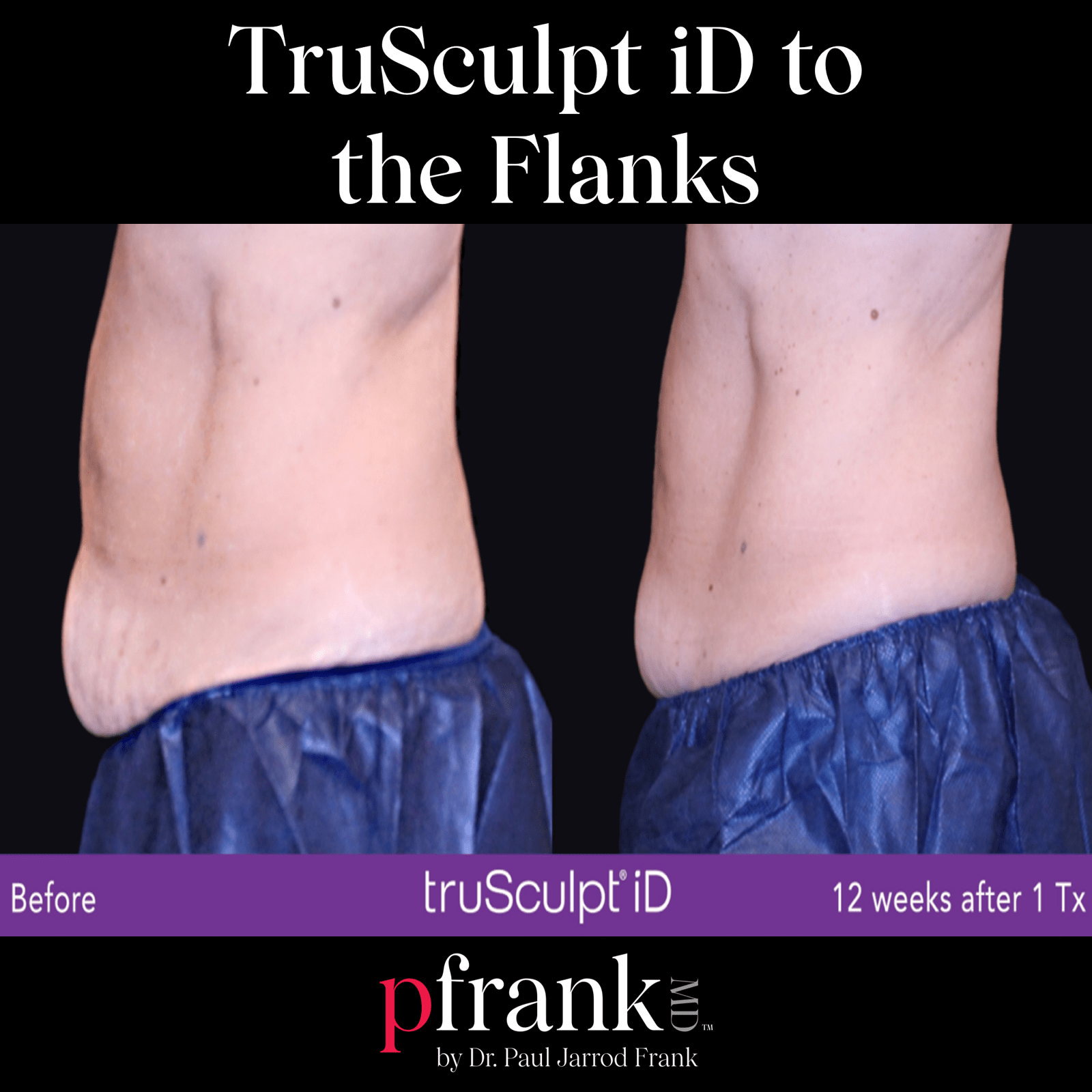 truSculpt iD treatment image 1 - October 2023