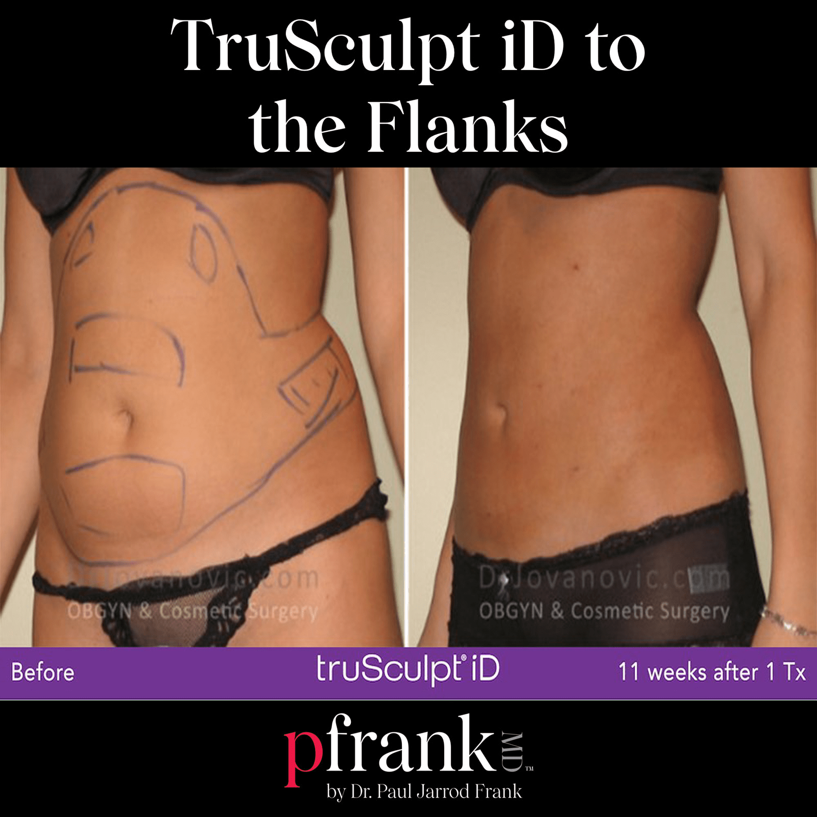 truSculpt iD treatment image 2 - October 2023