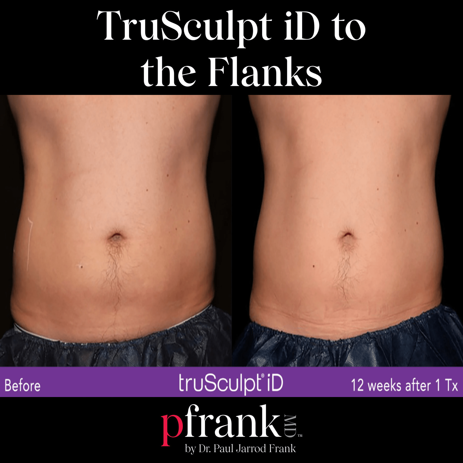 truSculpt iD treatment image 3 - October 2023
