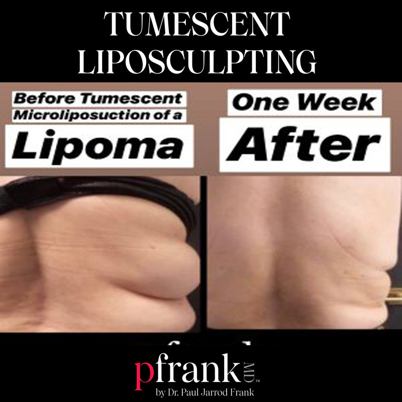 Tumescent liposuction image 1 - October 2023