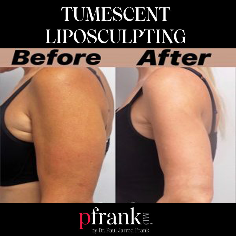 tumescent liposculpting before and after