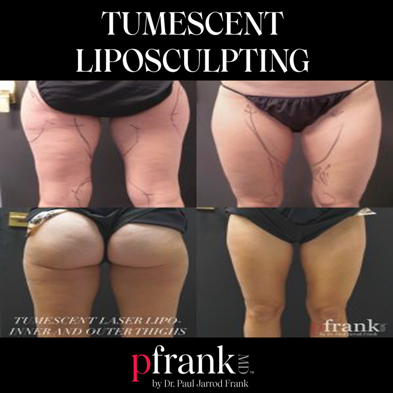 tumescent liposculpting before and after