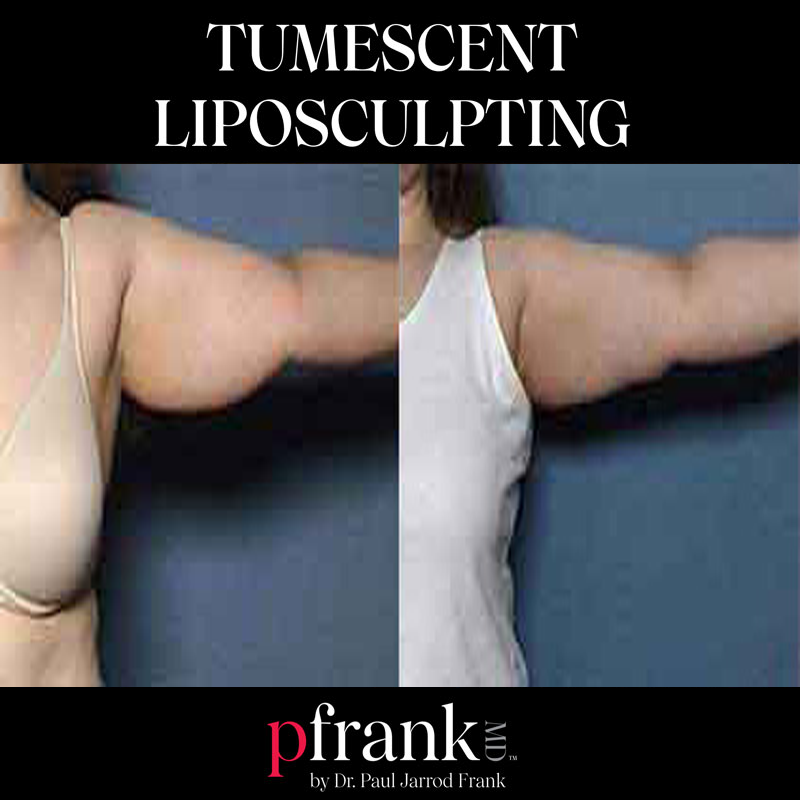 tumescent liposculpting before and after