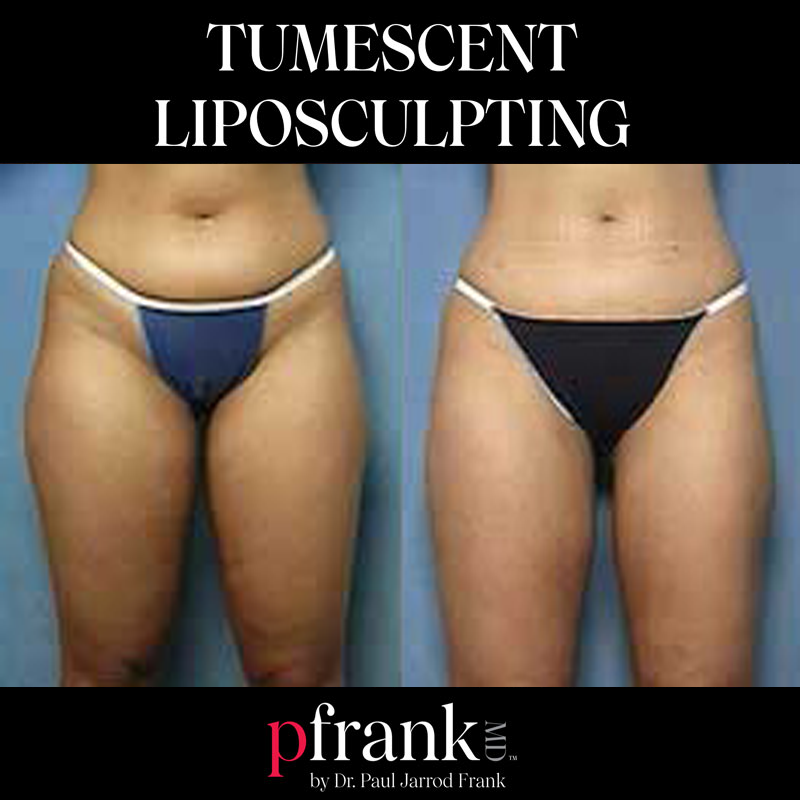 Tumescent liposuction image 5 - October 2023