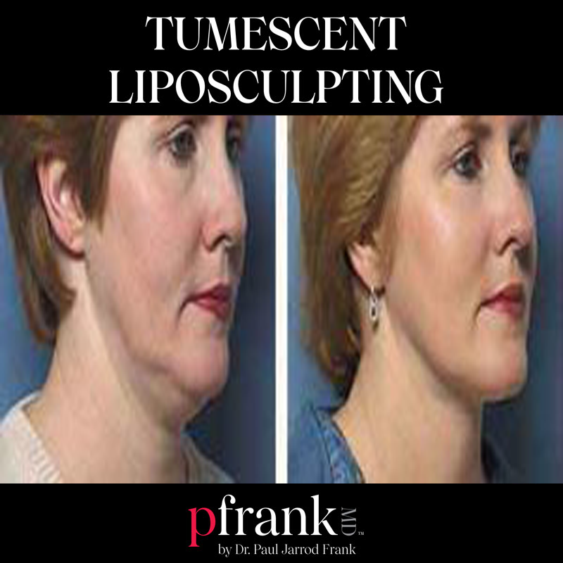 tumescent liposculpting before and after