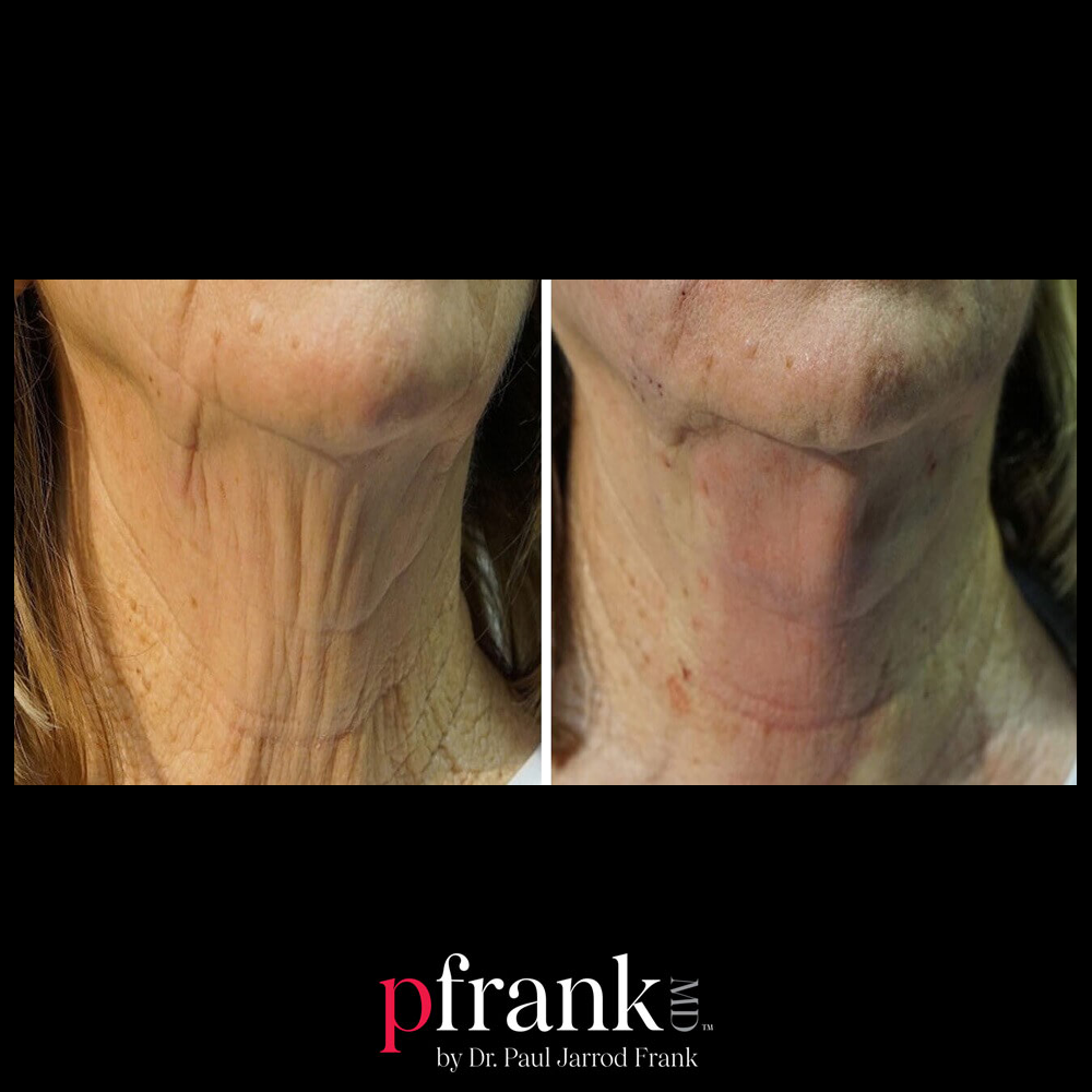 PFRANKMD thread lift before and after results - November 2023