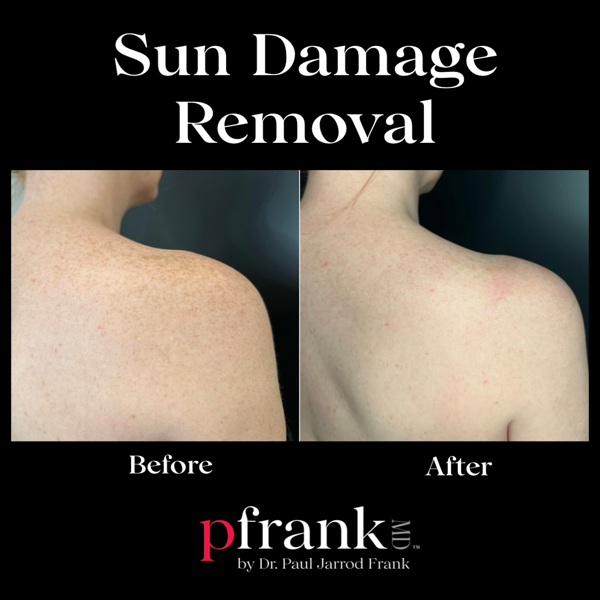 Sun damage removal treatment before and after - February 2024