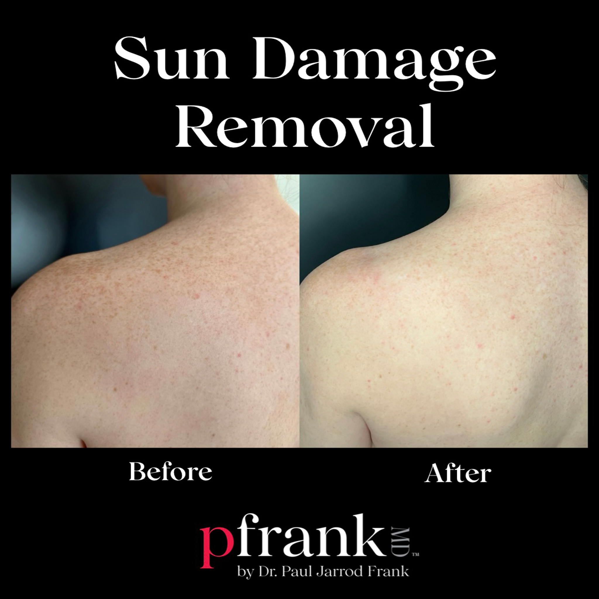 Sun damage removal treatment results - February 2024
