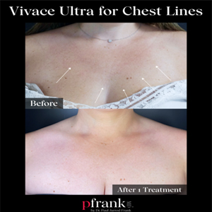 vivace radiofrequency microneedling before and after