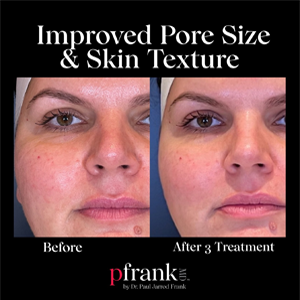 vivace radiofrequency microneedling before and after