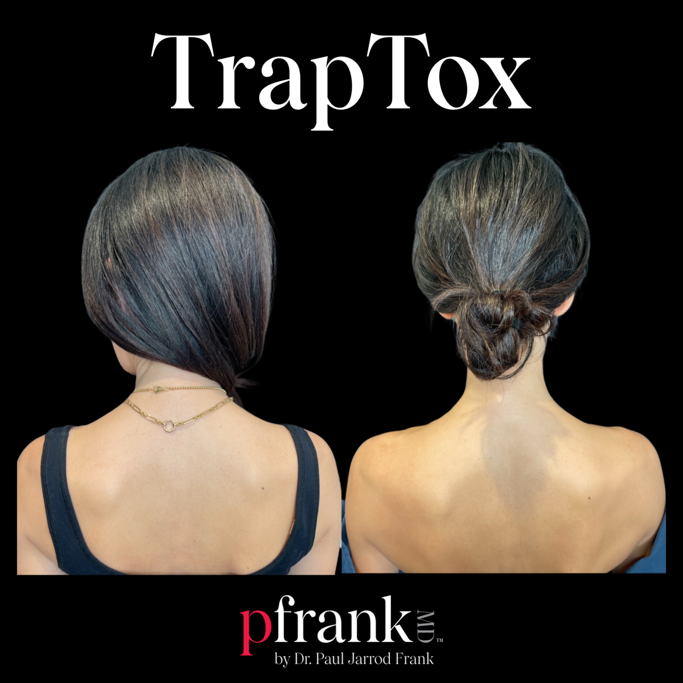 TRAPTOX before and after results - May 2024