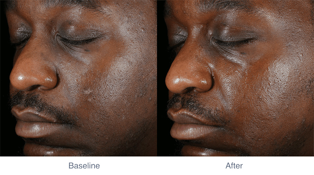 MIRIA skin tightening before and after - July 2024