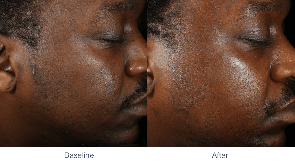 MIRIA skin tightening before and after - Photo 2 - July 2024