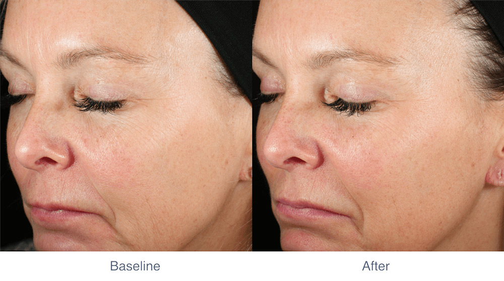 MIRIA skin tightening before and after - Photo 3 - July 2024