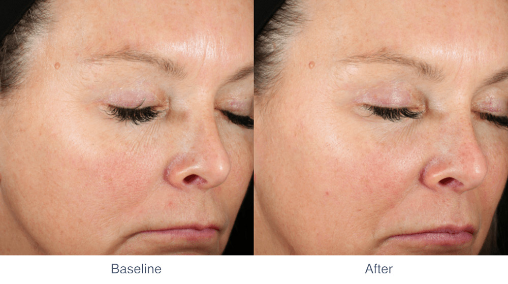 MIRIA skin tightening before and after - Photo 4 - July 2024