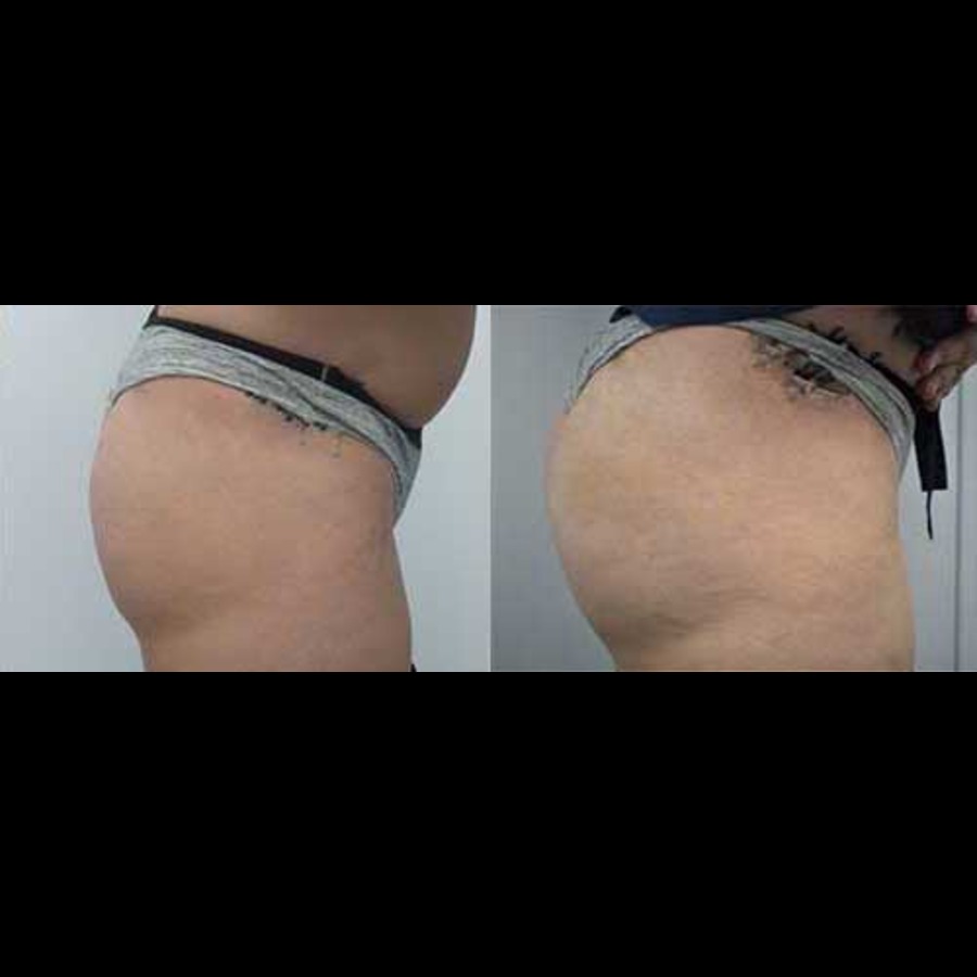 Sculptra Butt Lift Before and After photo by Dr. Paul Jarrod Frank of PFRANKMD in New York City, NY